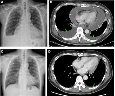 Case Report: Early diagnosis and bevacizumab-based chemotherapy for primary pericardial mesothelioma: a case with occupational asbestos exposure history